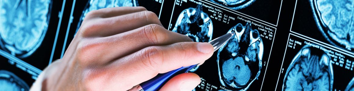 Alzheimer’s disease symptoms and prevention tips