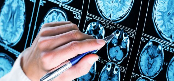Alzheimer’s disease symptoms and prevention tips