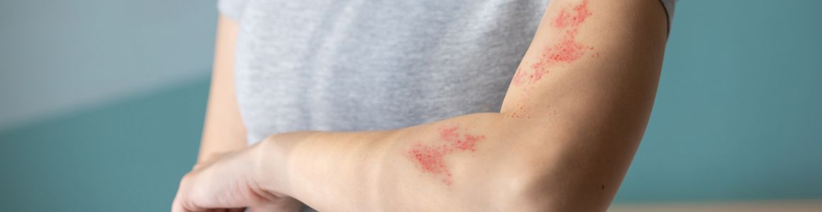 Managing shingles (herpes zoster) and its symptoms