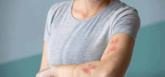 Managing shingles (herpes zoster) and its symptoms